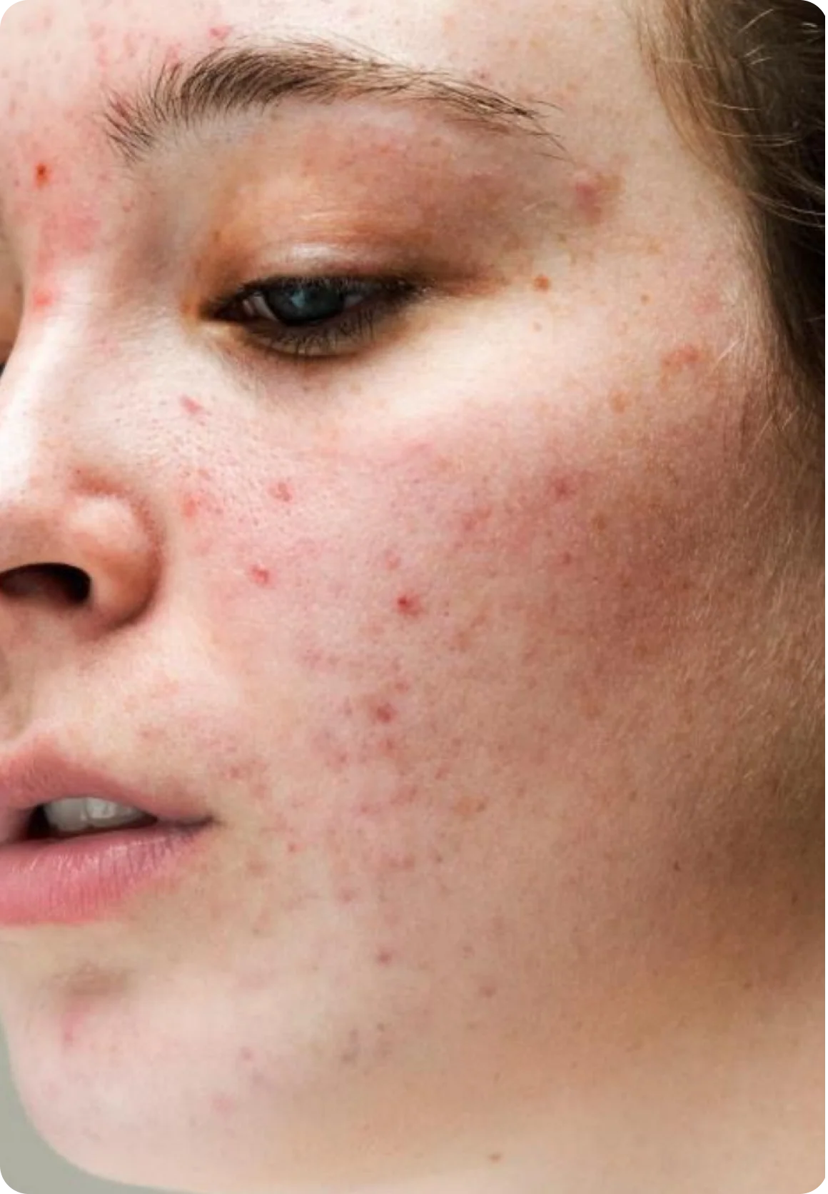 Acne & Spots