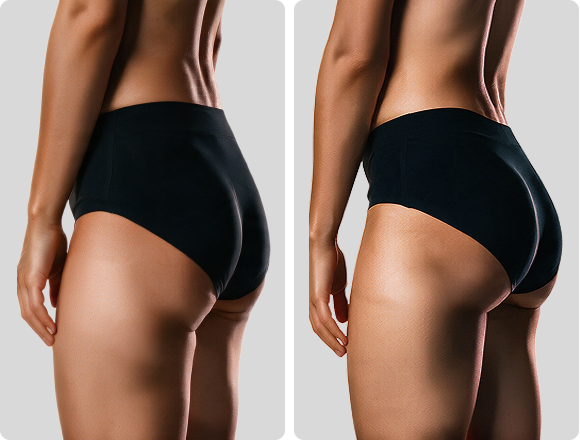 Flat & Weak Glutes
