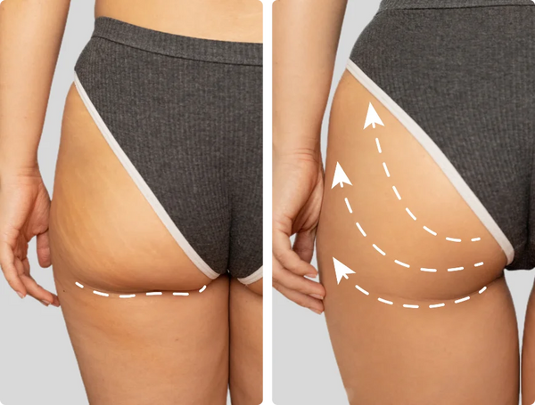 Glute Sagging results