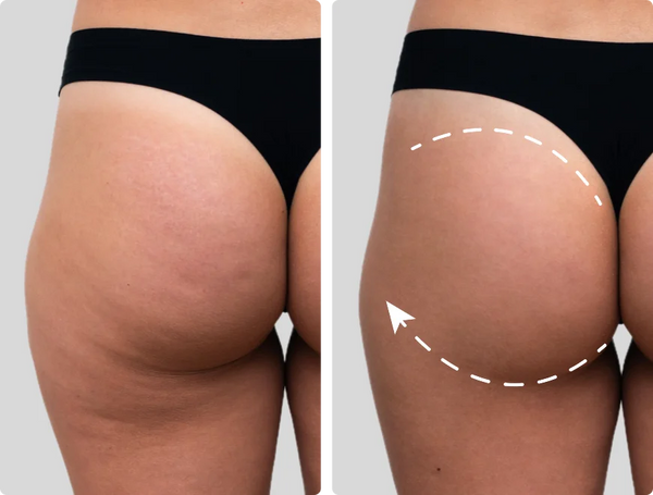 Stubborn Cellulite